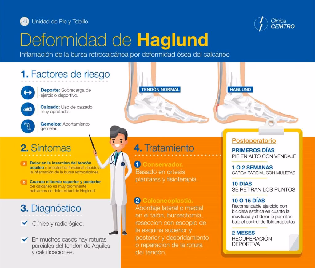 ¿Cómo evitar la deformidad de Haglund?