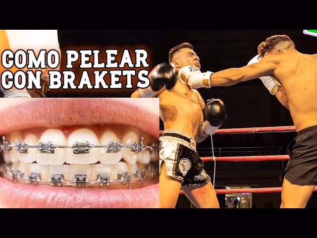 ¿Cuánto tiempo se tarda en hacer un brackets?